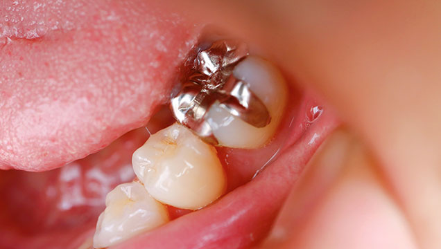 銀歯のデメリット