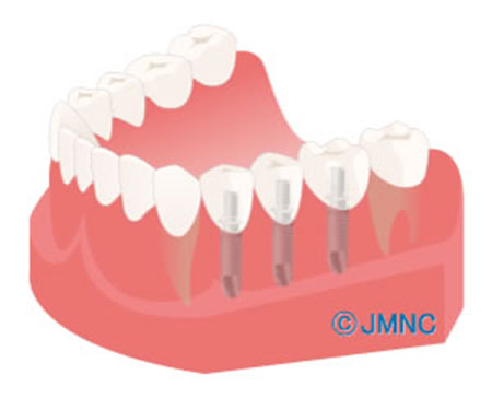 インプラントによる治療