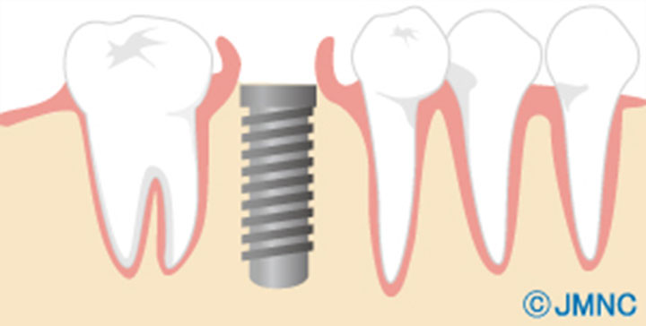 インプラント埋入